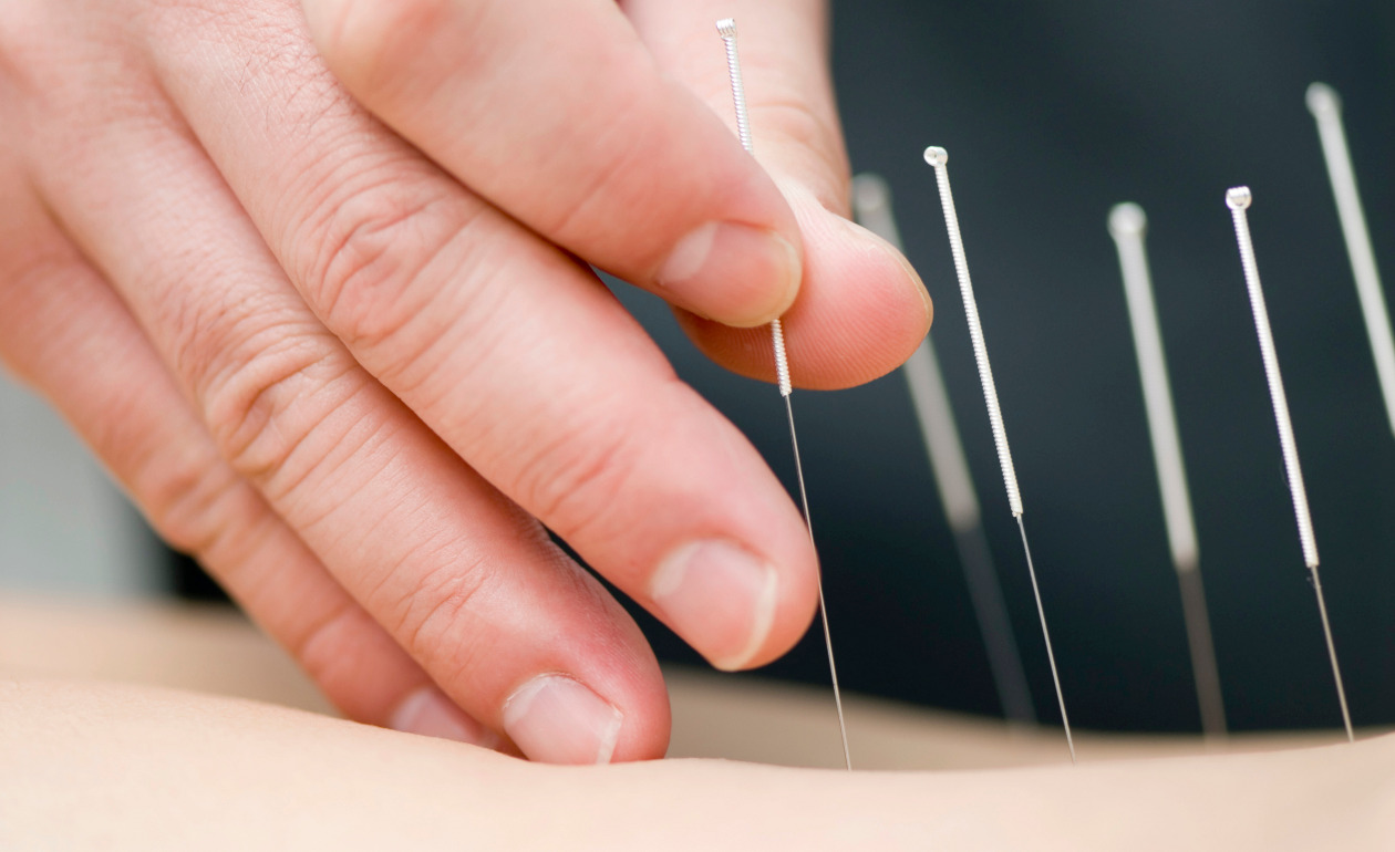 Existe tratamento gratuito de acupuntura em Ponta Negra