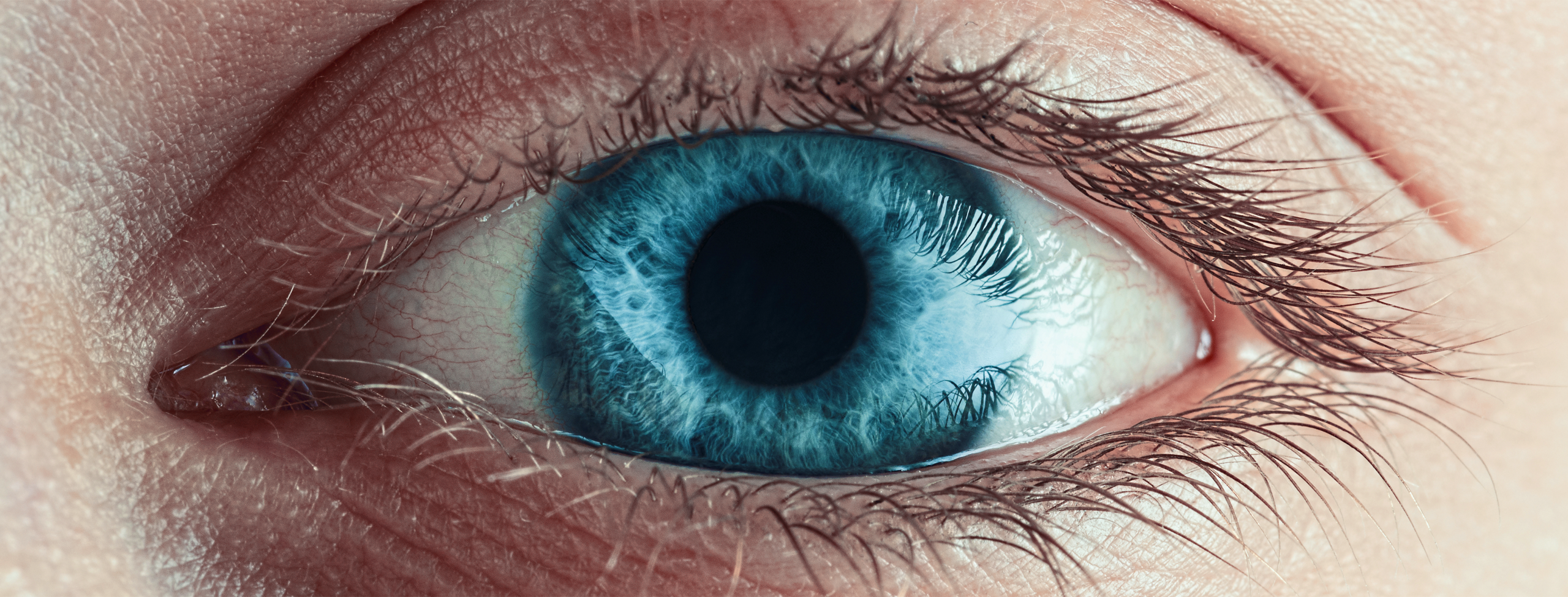 Glaucoma em Natal