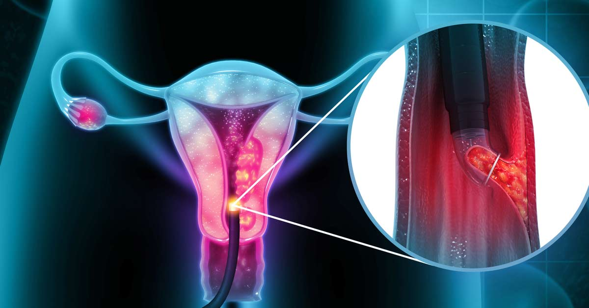 Estudo da UFRN confirma demora em pacientes com câncer de colo de útero